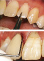 歯周病の応急処置